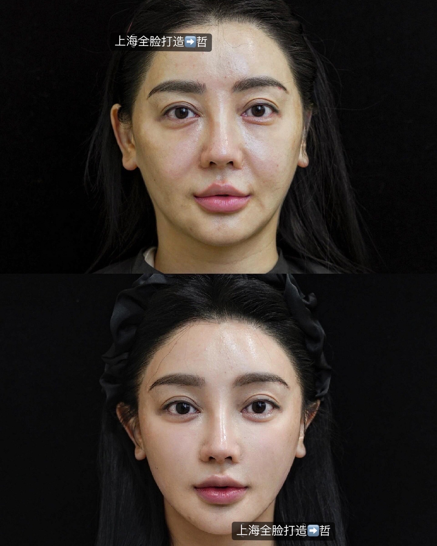 Consented Baby Face case 23