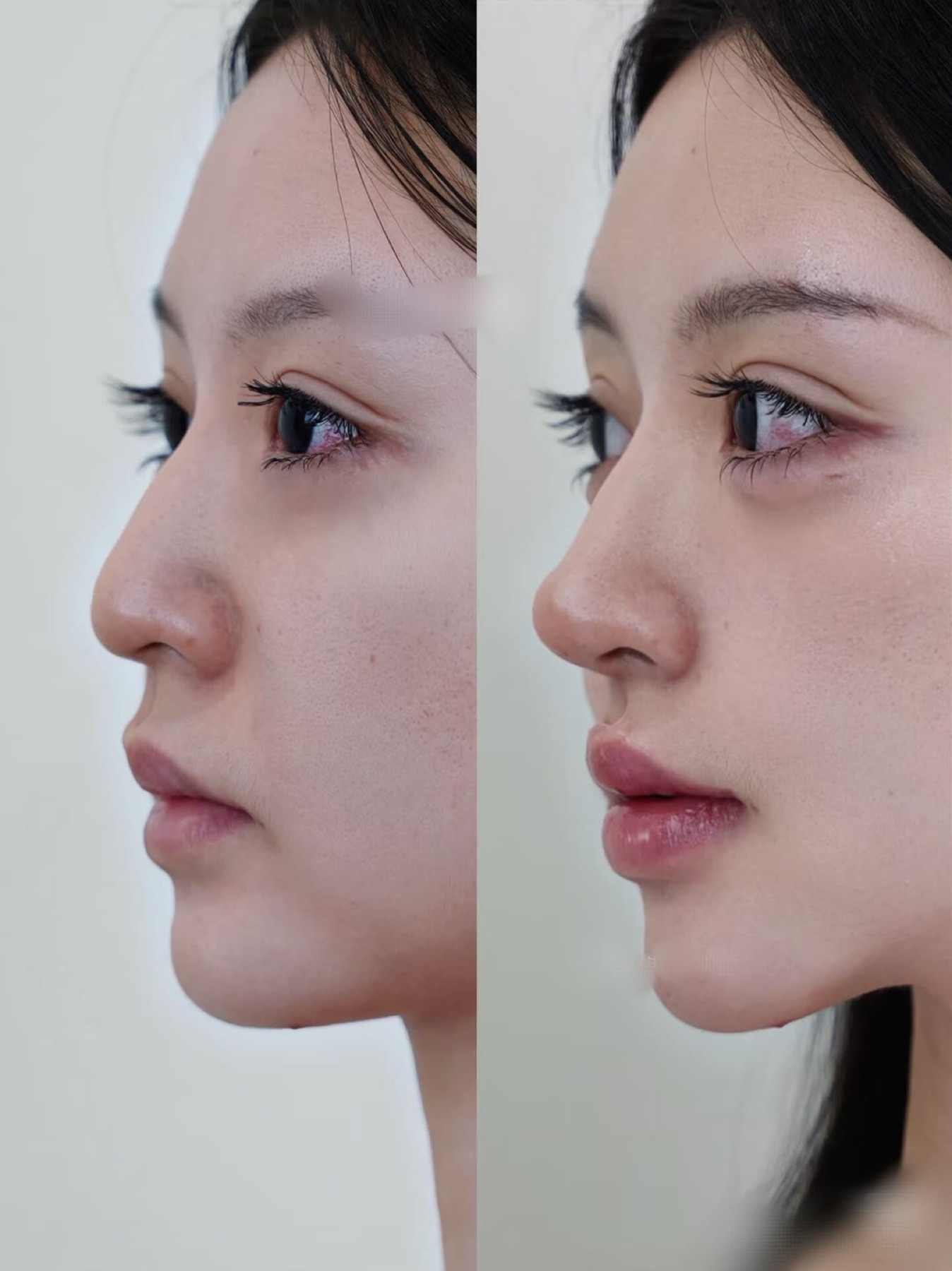 Consented Baby Face case 47