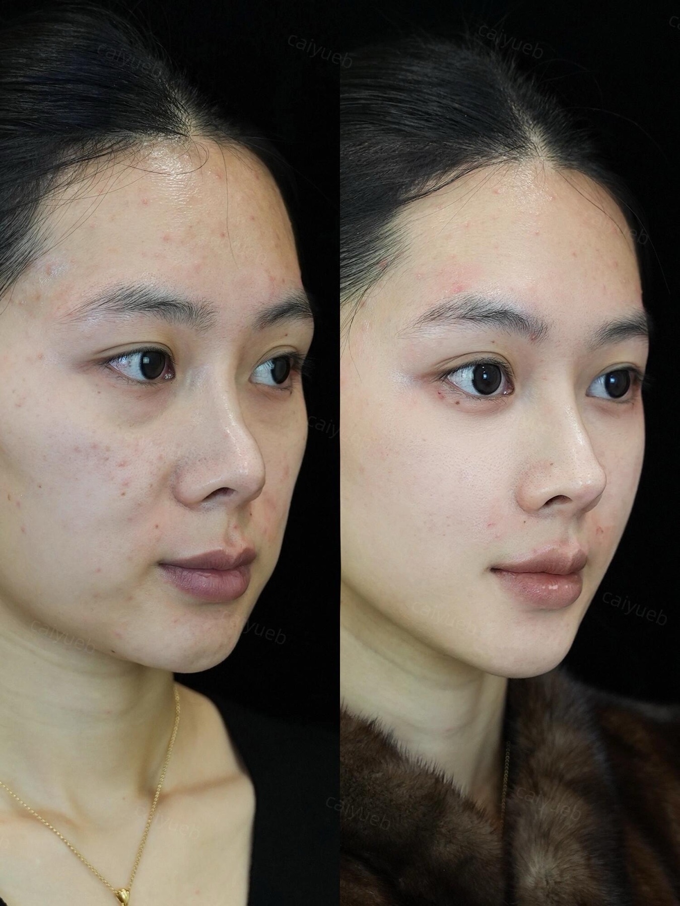 Consented Baby Face case 34
