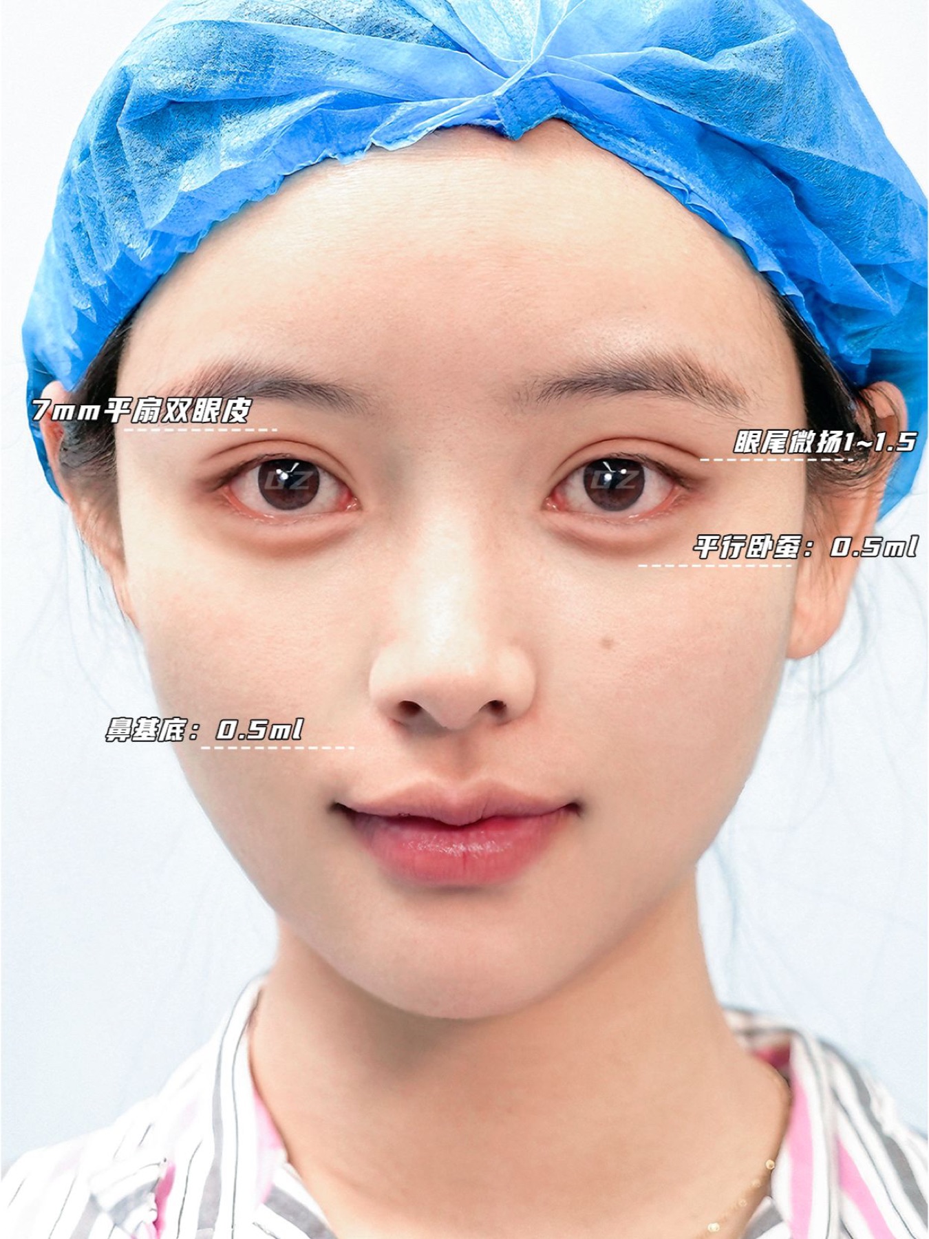 Consented Baby Face case 51