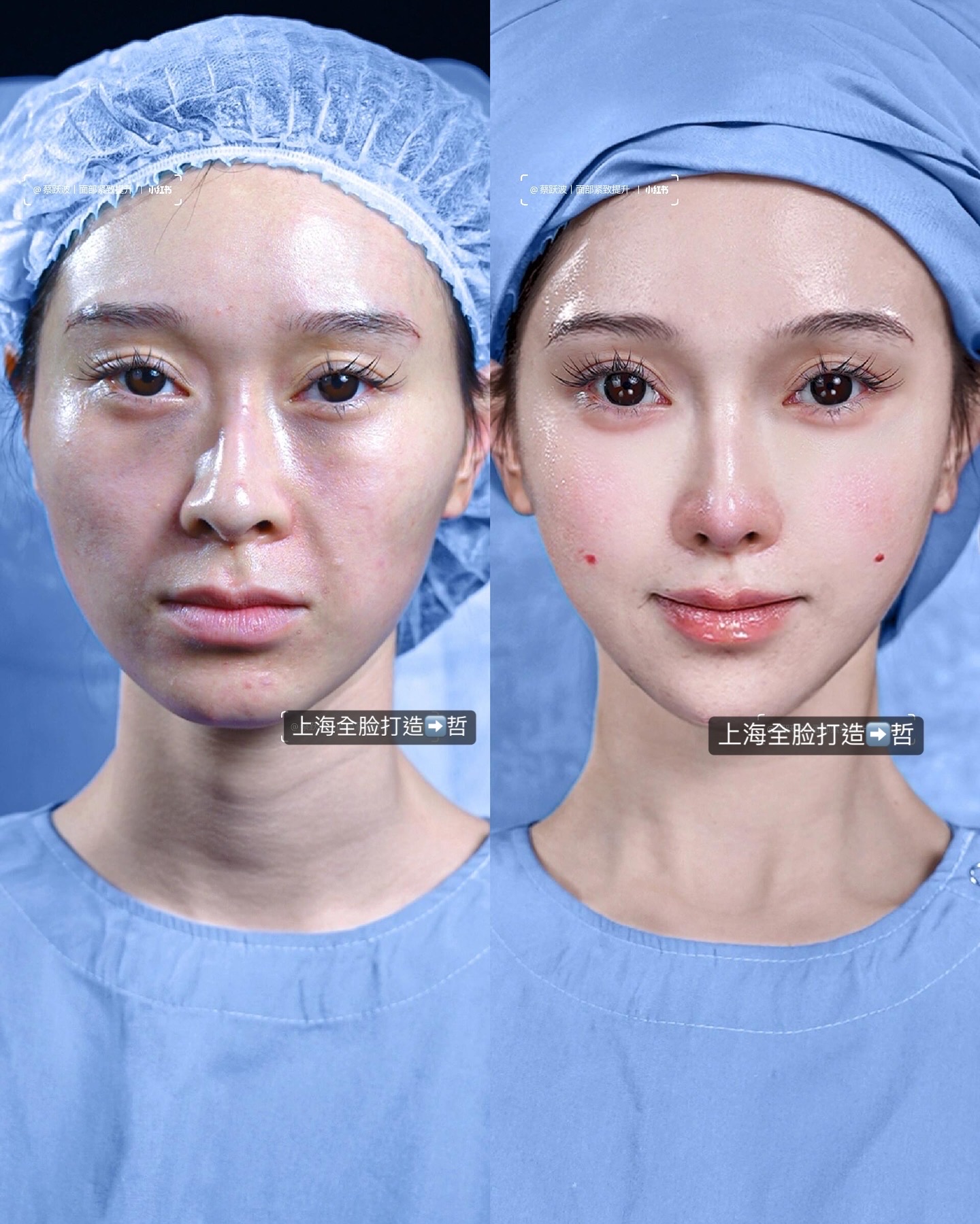 Consented Baby Face case 44