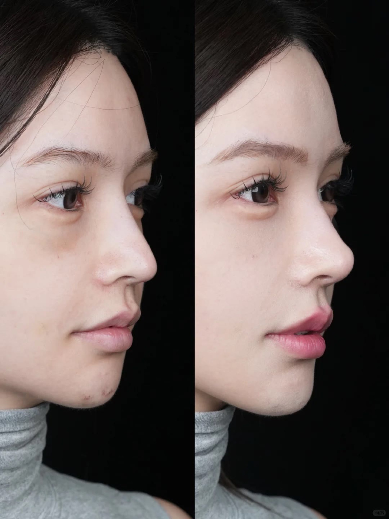 Consented Baby Face case 28