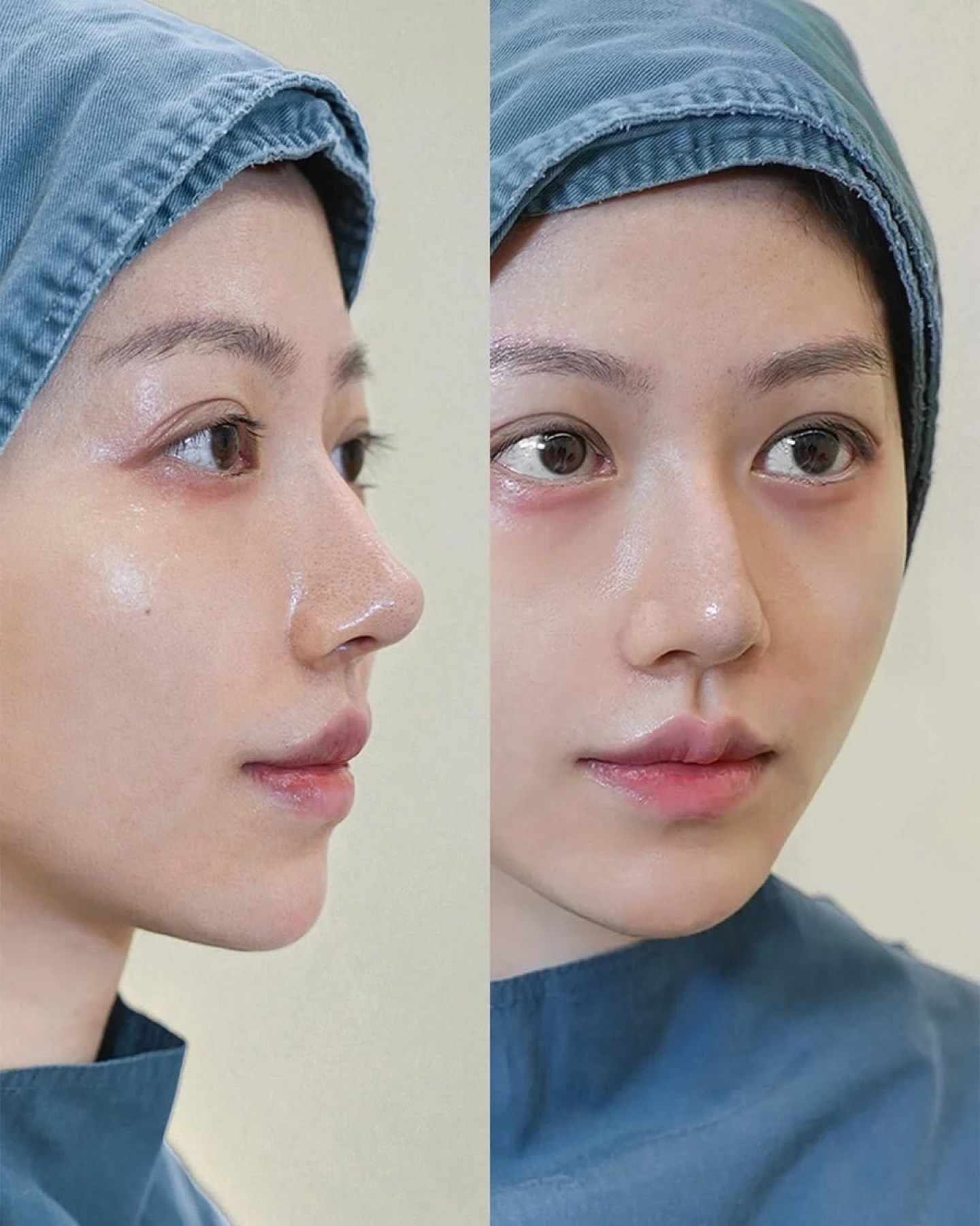 Consented Baby Face case 32