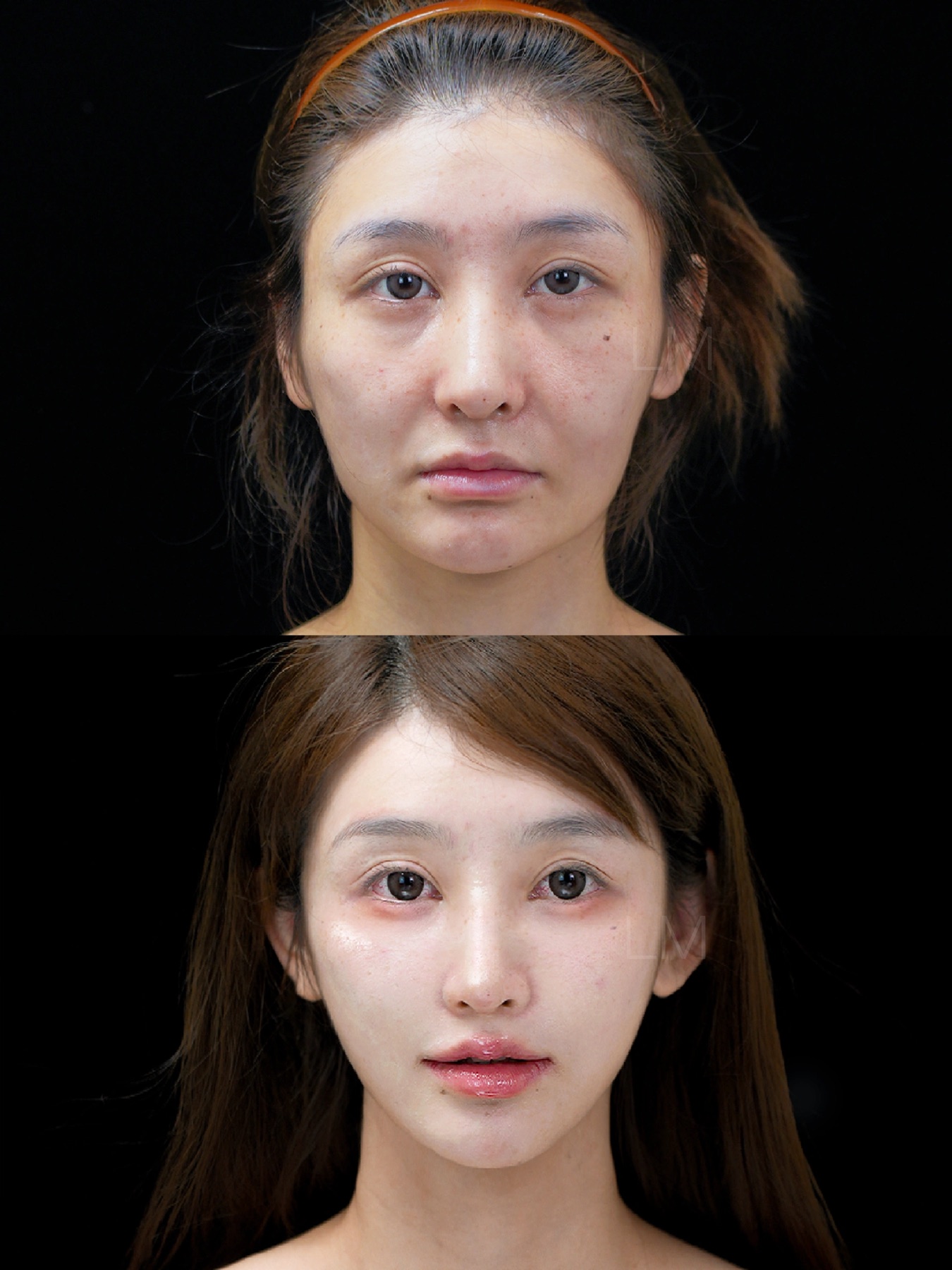 Consented Baby Face case 16
