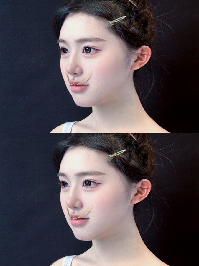 Historical facial lifting and Baby Face case 03