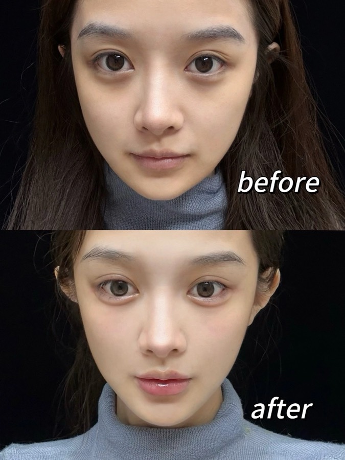 Historical facial lifting and Baby Face case 11